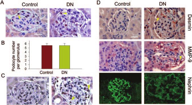 Podocyte EMT 305 Figure 9. De novo expression of desmin and MMP-9 and suppression of nephrin in podocytes of diabetic kidney in vivo.