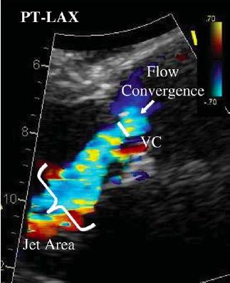 Aortic Insufficiency Echo Markers of Severe AI: Vena contracta width > 6 mm Important to