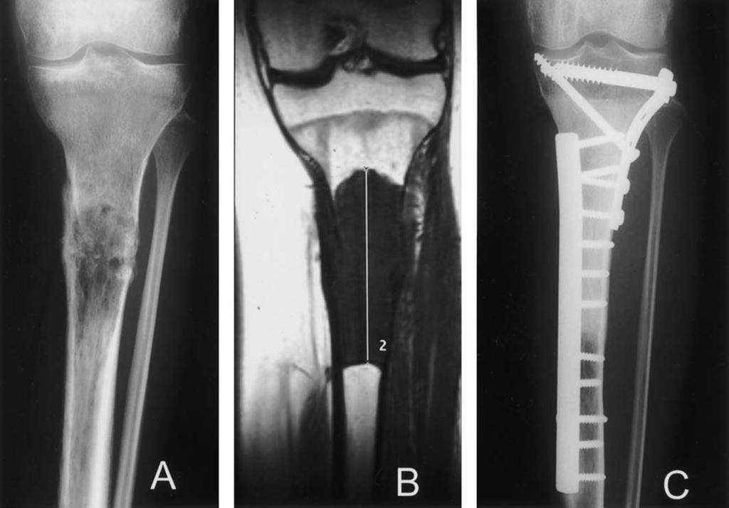 (A) An anteroposterior radiograph shows the osteosarcoma located at the proximal tibia.