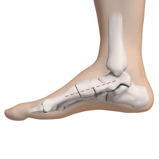 2 Approach Make a medial utility incision 1 cm below the medial malleolus, from the navicular down to the first metatarsal.