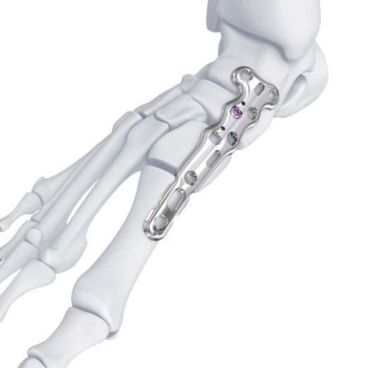 B VA LCP Medial Column Fusion Plate 3.5, 95 mm, Talus Extension To compress the naviculocuneiform joint: b 1) Insert a 3.
