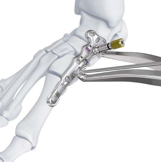VA LCP Medial Column Fusion Plates 3.5 b 3) Compress the joint using the compression forceps. Reference a3 for specific technique.