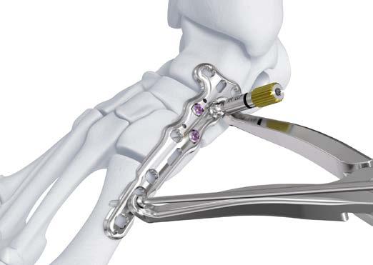 To compress the first tarsometatarsal joint: b 5) Insert a 2.8 mm compression wire into the elongated screw hole within the metatarsal portion of the plate. Reference a2 for specific technique.