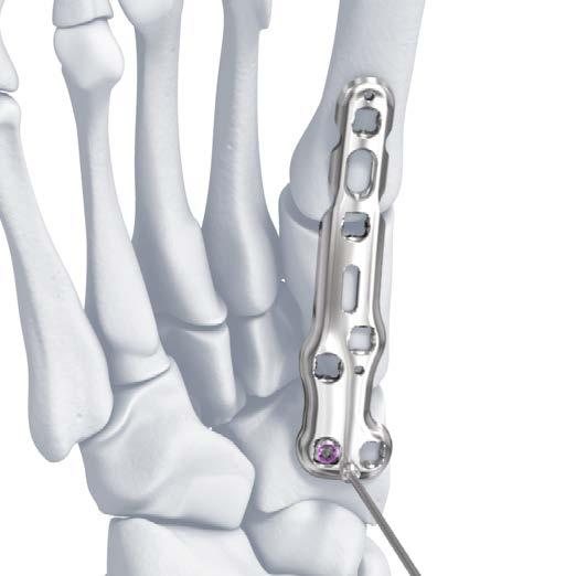C VA LCP Medial Column Fusion Plantar Plate 3.5, 78 mm To compress the naviculocuneiform joint: c 1) Insert a 3.