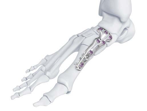 5 are indicated for deformities, severe arthritis, and arthrosis of the medial column consisting of the first