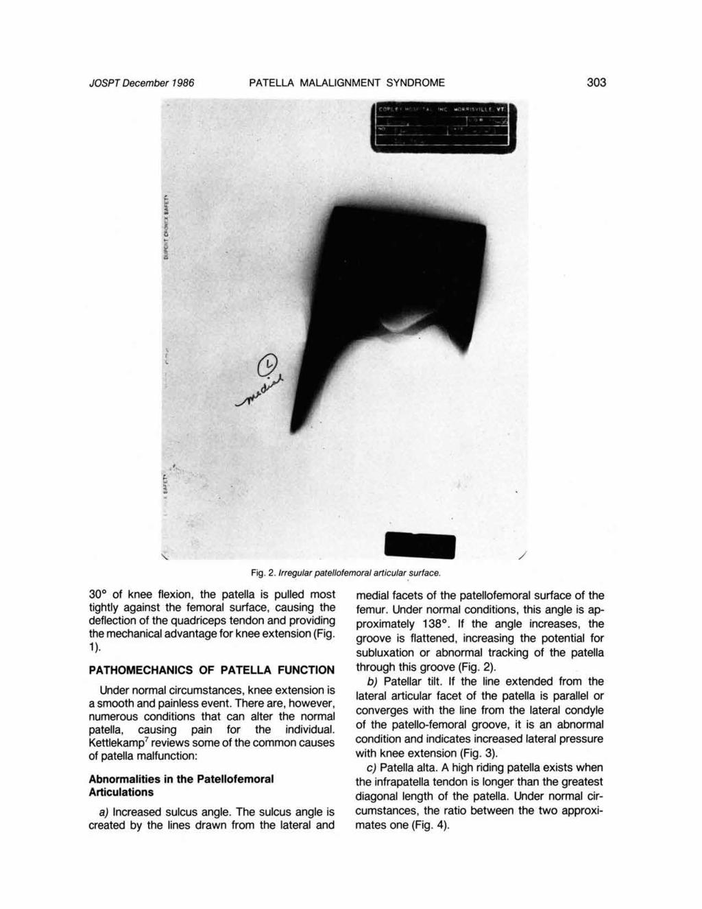 JOSPT December 1986 PATELLA MALALIGNMENT SYNDROME Fig. 2. Irregular patellofemoral articular surface.
