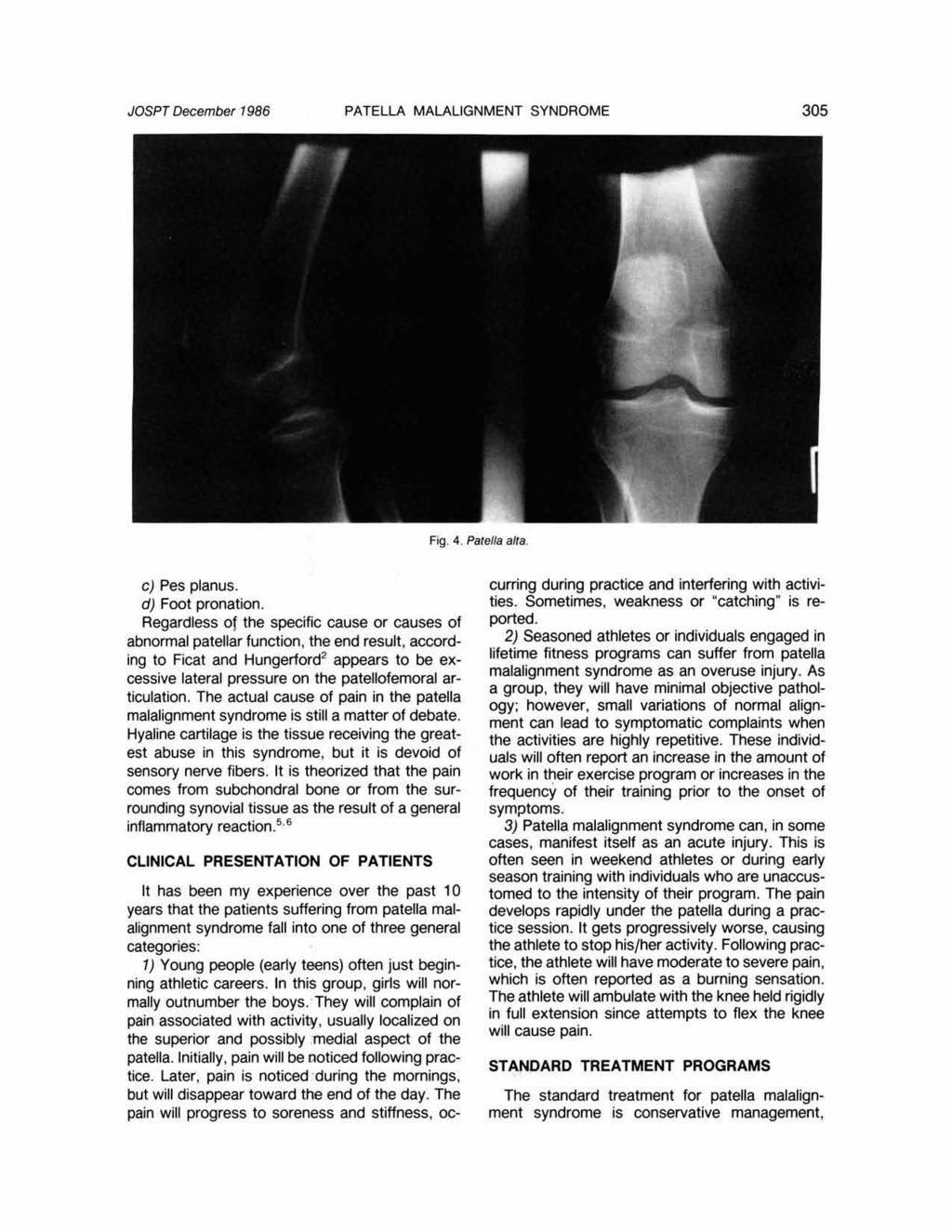 JOSPT December 1986 PATELLA MALALIGNMENT SYNDROME 305 c) Pes planus. d) Foot pronation.