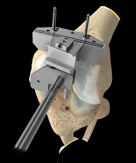 10 Vanguard ID Total Knee Surgical Technique 9 mm Figure 12 Figure 13 Distal Femoral Resection (cont.) Option 2: Fixed Distal Femoral Resection Guide (cont.