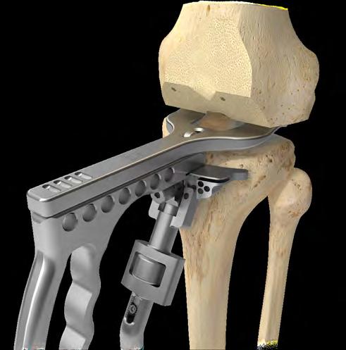 16 Vanguard ID Total Knee Surgical Technique Fine-tune Adjustment Figure 22 Figure 23 Tibial Resection (cont.