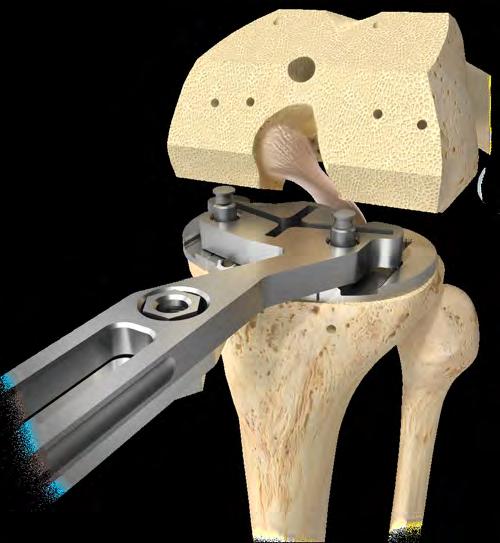 21 Vanguard ID Total Knee Surgical Technique Figure 31 Tibial Preparation Place the knee in maximum flexion and sublux the tibia anteriorly using a PCL retractor and place a Z-retractor medially and