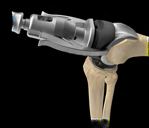 23 Vanguard ID Total Knee Surgical Technique Final Trial Reduction Figure 34 Figure 35 Femur With all bone surfaces and soft tissues prepared, complete a trial reduction.