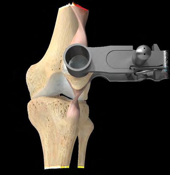 3-peg patellar component: Place the appropriately sized 3-peg drill guide onto the resected patella and use the 1/4 inch patellar drill to prepare for the