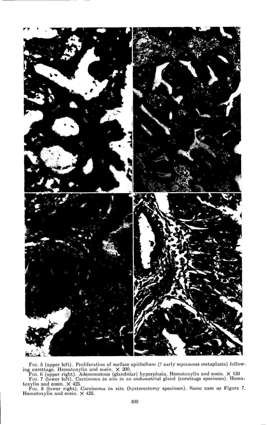 F I G. 5 (upper left). Proliferation of surface epithelium (? early squamous metaplasia) following curettage.