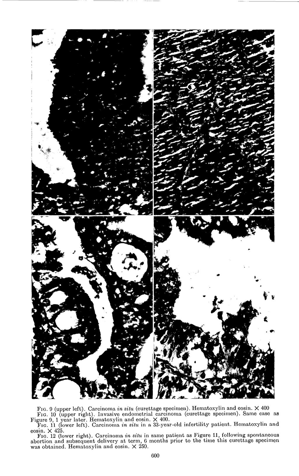 F i e. 9 (upper left). Carcinoma in situ (curettage specimen). Hematoxylin and eosin. X 400 F I G. 10 (upper right).