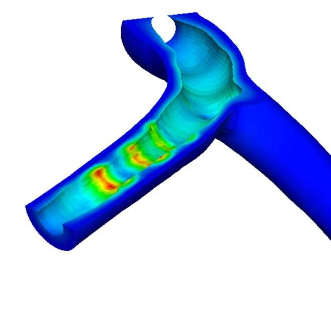 Stent design & implantation Simulation of stent expansion 3.5 Diameter [mm] 3.0 2.5 2.