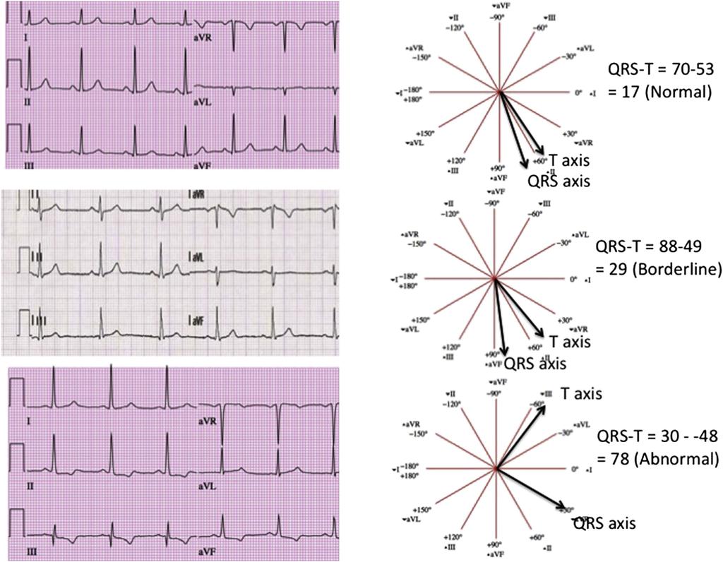Preventive Cardiology/Frontal QRS-T Angle and CVD Events 1881 Figure 1. An illustration of the calculation and definition of normal, borderline, and abnormal QRS-T angle.
