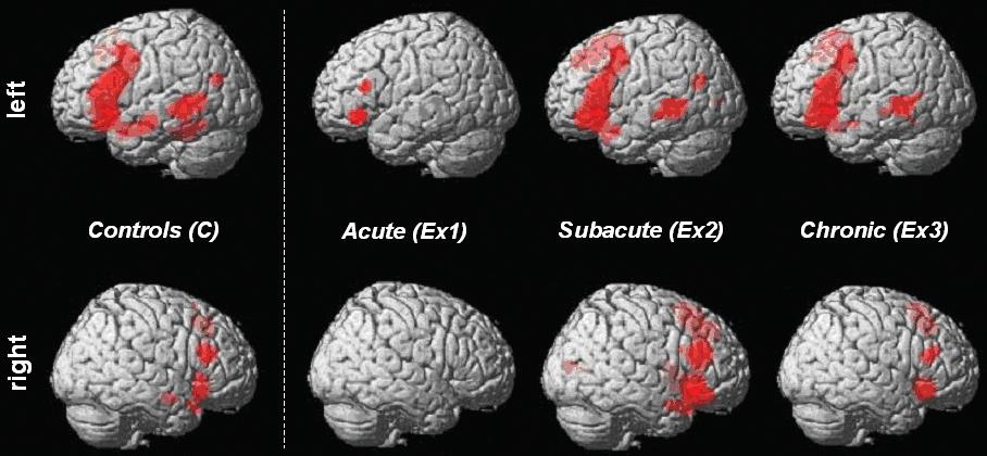 1378 Brain (2006), 129, 1371 1384 D. Saur et al. Fig. 3 (A) Three phases of language reorganisation.