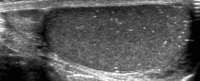 Scrotal ultrasonography was done in longitudinal and transverse sections by using a scanning device with a high-frequency linear array transducer and a center frequency of 14 MHz (SIEMENS ACUSON