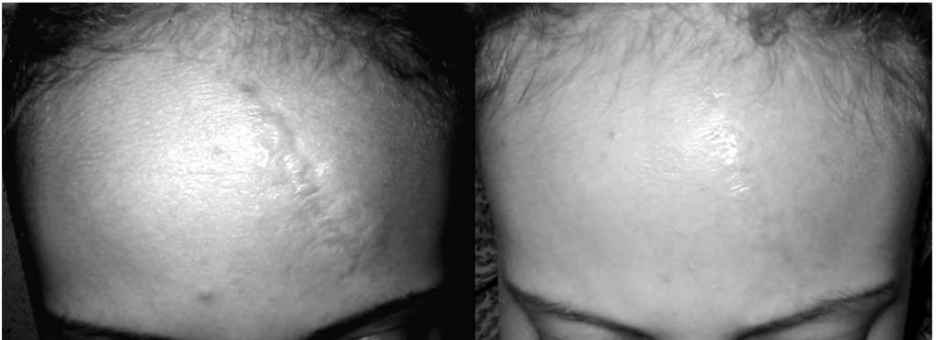 126 Augmentation of Atrophic Deprssed Scars Utilizing Fig. (4): Case No.