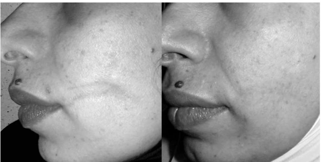 abscess, before surgery to the left, and after surgery to the right. Fig. (6): Case No.