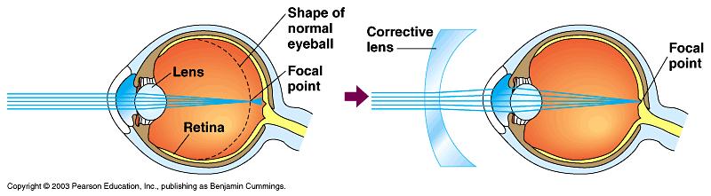 Nearsightedness or myopia is caused by the eye being a bit too long and so the lens focuses an image short of the retina.