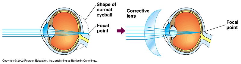 Farsightedness or hyperopia is caused by the eye being too short and so the lens focuses an image behind the retina.