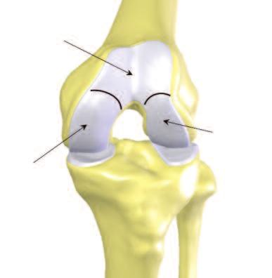 Understanding Osteoarthritis Please speak with your physician if your symptoms aren t responding to non-surgical solutions, or your pain can no longer be controlled by medication.