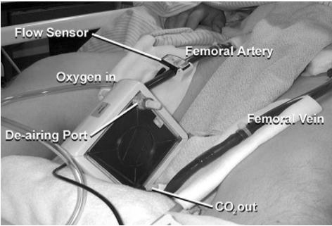 ECMO For reversible respiratory failure