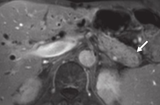 D, Transverse T2-weighted MR image of pancreatic head shows nonspecific low-signal-intensity