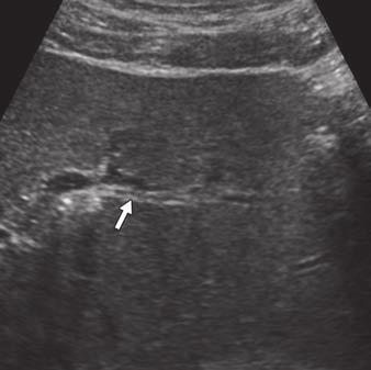 Horger et al. G D Fig. 3 (continued) 67-year-old man with jaundice and abdominal discomfort.