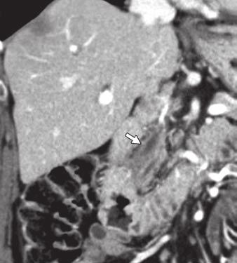 4 70-year-old woman with systemic IgG4- related sclerosing disease and jaundice at initial