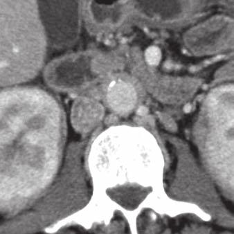 E, Transverse contrast-enhanced CT image shows retroperitoneal fibrosis in