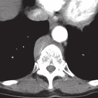 Coronal contrast-enhanced CT image shows bilateral nodular isoattenuating
