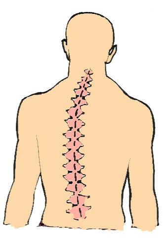 Postural Problems: Scoliosis Most severe condition Characterized by a