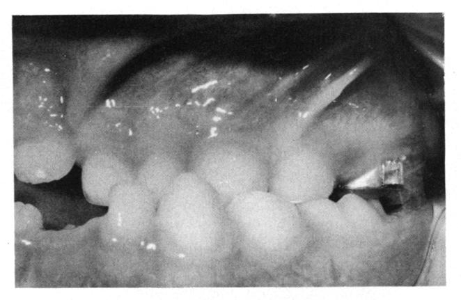 TREATMENT Ankylosed teeth or osseointegrated titanium implants can be used as anchorage for protraction forces to cause
