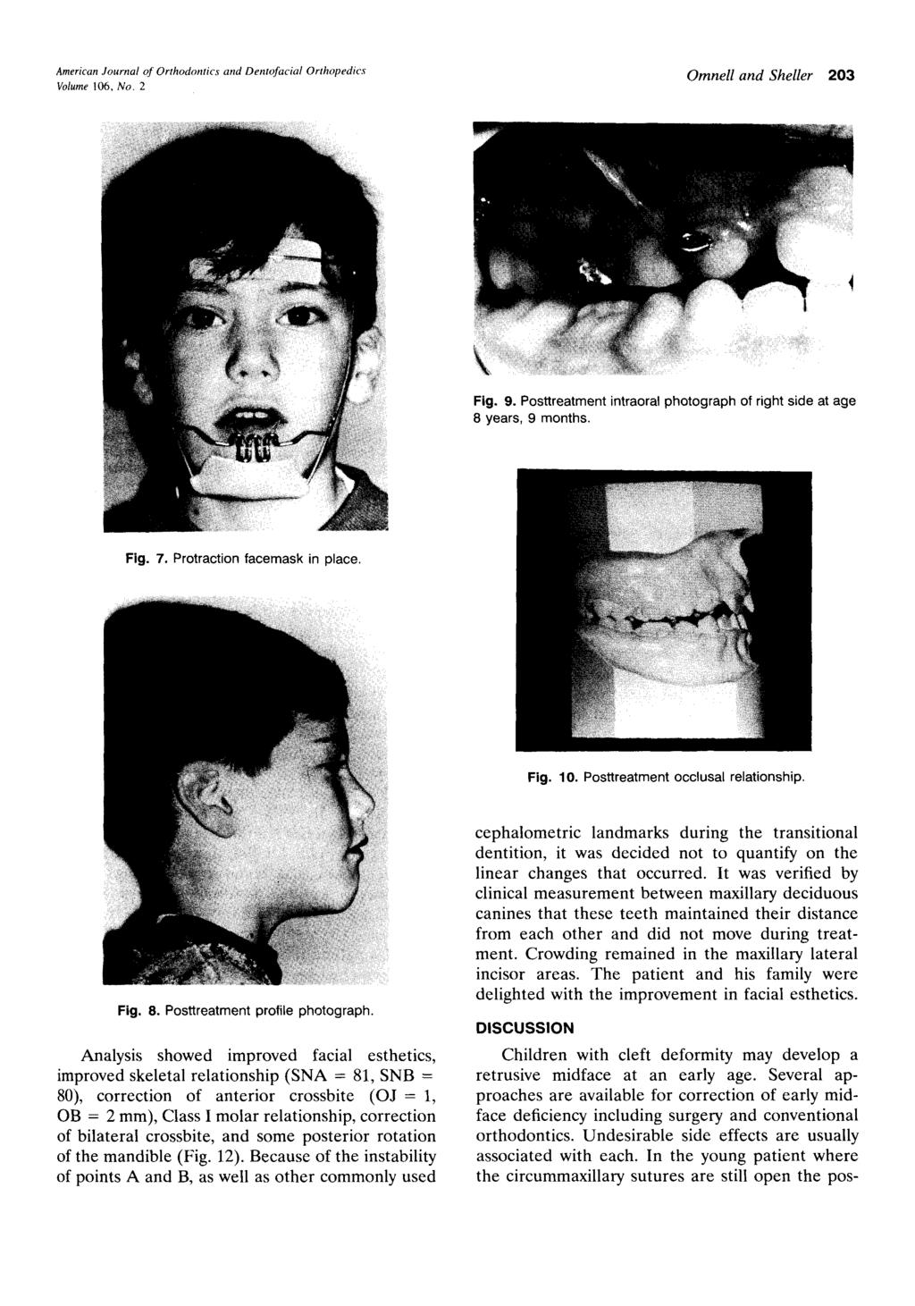 Volume 106, No.2 Omnell and Sheller 203 Fig. 9. Posttreatment intraoral photograph of right side at age 8 years, 9 months. Fig. 7.