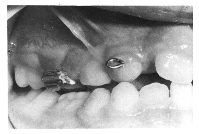 did not move during treatment. Crowding remained in the maxillary lateral incisor areas.