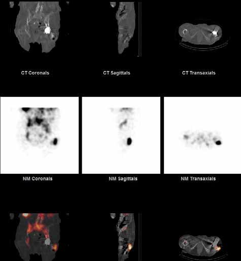 Dual Isotope SPECT/CT