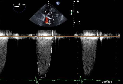 Real time Three-dimensional (RT-3D) Recently, RT-3D cardiac echocardiography imaging has become popular, especially for perioperative noninvasive imaging of intracardiac lesions such as valvular and