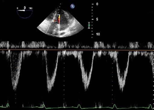Basic Physics of Ultrasound in Transesophageal Echocardiography Reverberation Reverberation artifact causes evenly spaced lines at increasing depths and is caused by sound reflecting back and forth