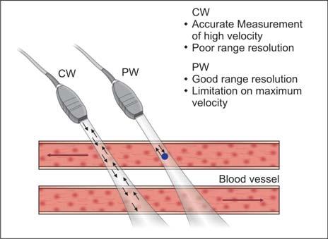 6: Pulse wave (PW) and colour Doppler across aortic valve (deep transgastric view) The ultrasound probe cannot produce a pulse that travels purely in one direction.