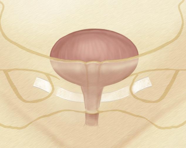 Q: What are some treatment options? A: Stress urinary incontinence can be treated in several ways, depending on the exact nature of the incontinence and its severity.