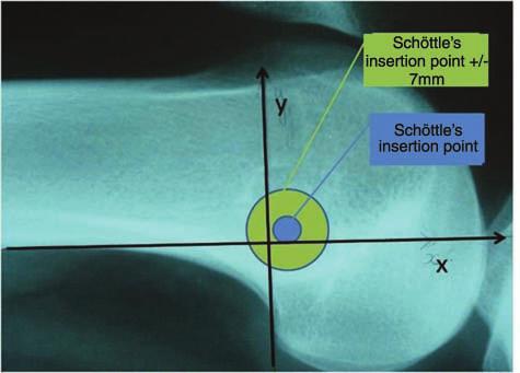 The green zone represents the proper positioning of the femoral tunnel with regard to Schöttle s point 67 mm.