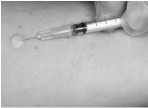 Department of Health (DoH) World Health Organization (WHO) Intradermal Injection All injections to the eyelid and the