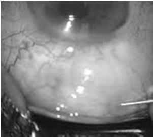 medication can not be administered Subconjunctival/Sub-Tenon s Injection Possible Advantages Markedly increased