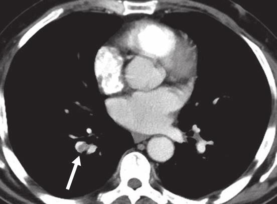 Pulmonary Emboli Missed on CT of the Abdomen electronic word search system (Radsearch). All reports were reviewed to ensure the positivity for PE.