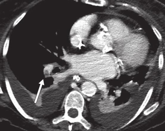 Lim et al. Fig. 2 92-year-old woman with history of recent antrectomy due to duodenal ulcer. Missed unknown pulmonary embolism (PE) was found on contrast-enhanced CT of abdomen and pelvis.