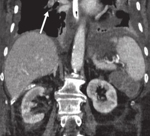 A, Axial 4-mm-thick image shows filling defect (arrow) in segmental branch of right lower lobe pulmonary artery that was not initially reported.