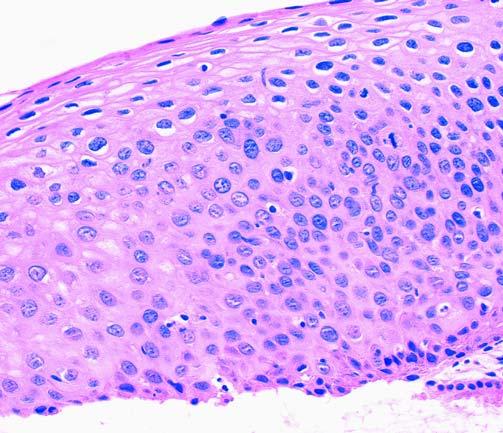 In the remaining cases, no histologic evidence of dysplasia or HPV cytopathic changes was noted during review.