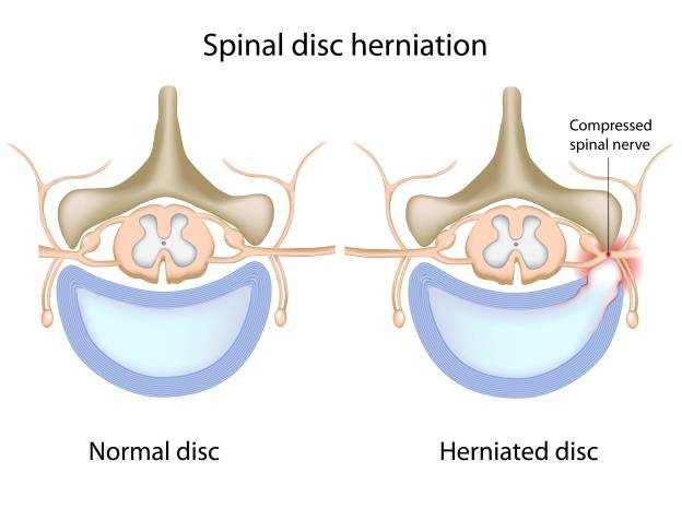 Herniated Disc if the disc